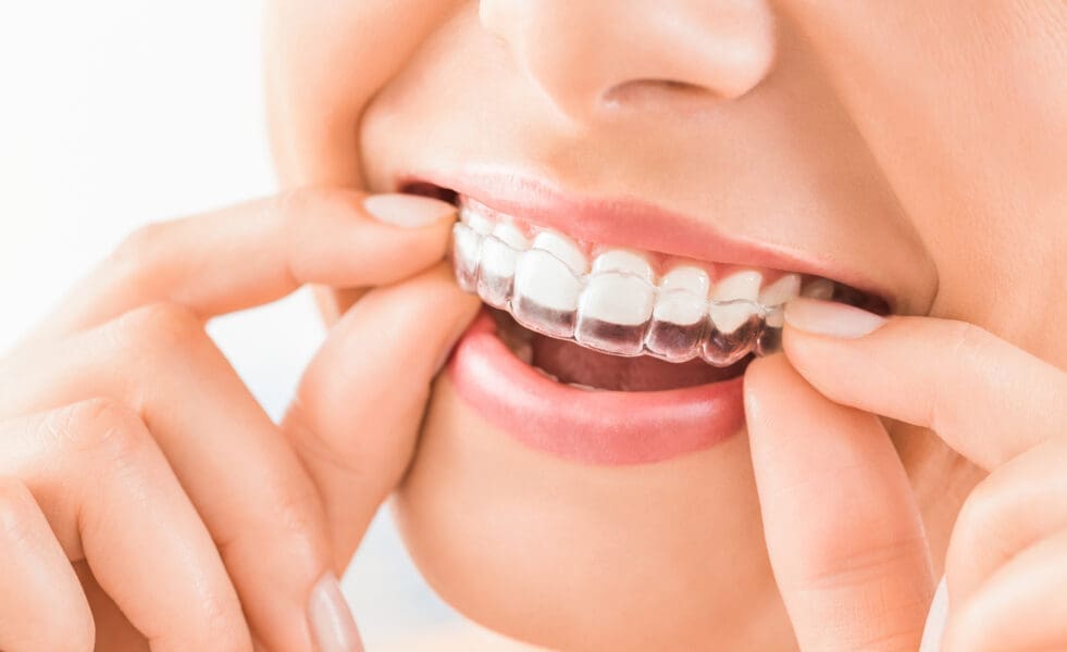 Persoană aplicând un aligner Invisalign pe dantură, vedere de aproape